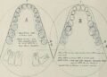 Deep Learning Algorithm Can Detect Occlusal Caries From Photographs